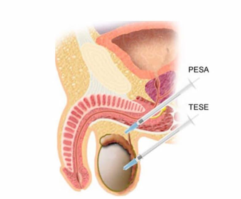 Male Fertility (TESA / SPERM FREEZING)